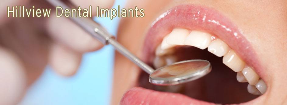 Implants