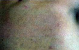 Acne Treatment After
