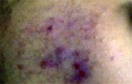 Acne Treatment Before
