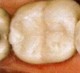 Fillings After Fillings After