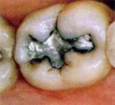 Fillings Before Fillings Before