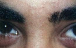 Hair Removal After Hair Removal After