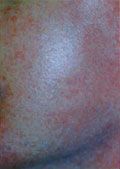 Vein Removal After 1 Vein Removal After 1