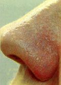 Vein Removal After 2 Vein Removal After 2