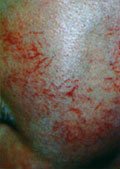 Vein Removal Before 1 Vein Removal Before 1
