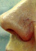 Vein Removal Before 2 Vein Removal Before 2