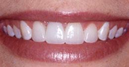 After Veneers After Veneers