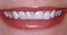 Before Veneers Before Veneers