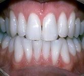 Whitening After