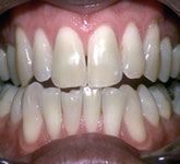Whitening Before