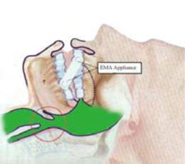 Airway Airway